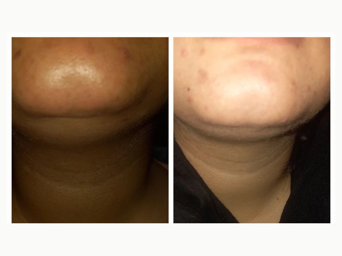Double chin treatment before and after