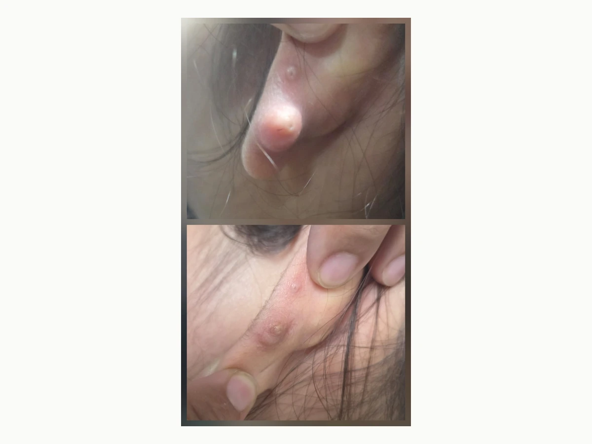 Keloid removal before and after