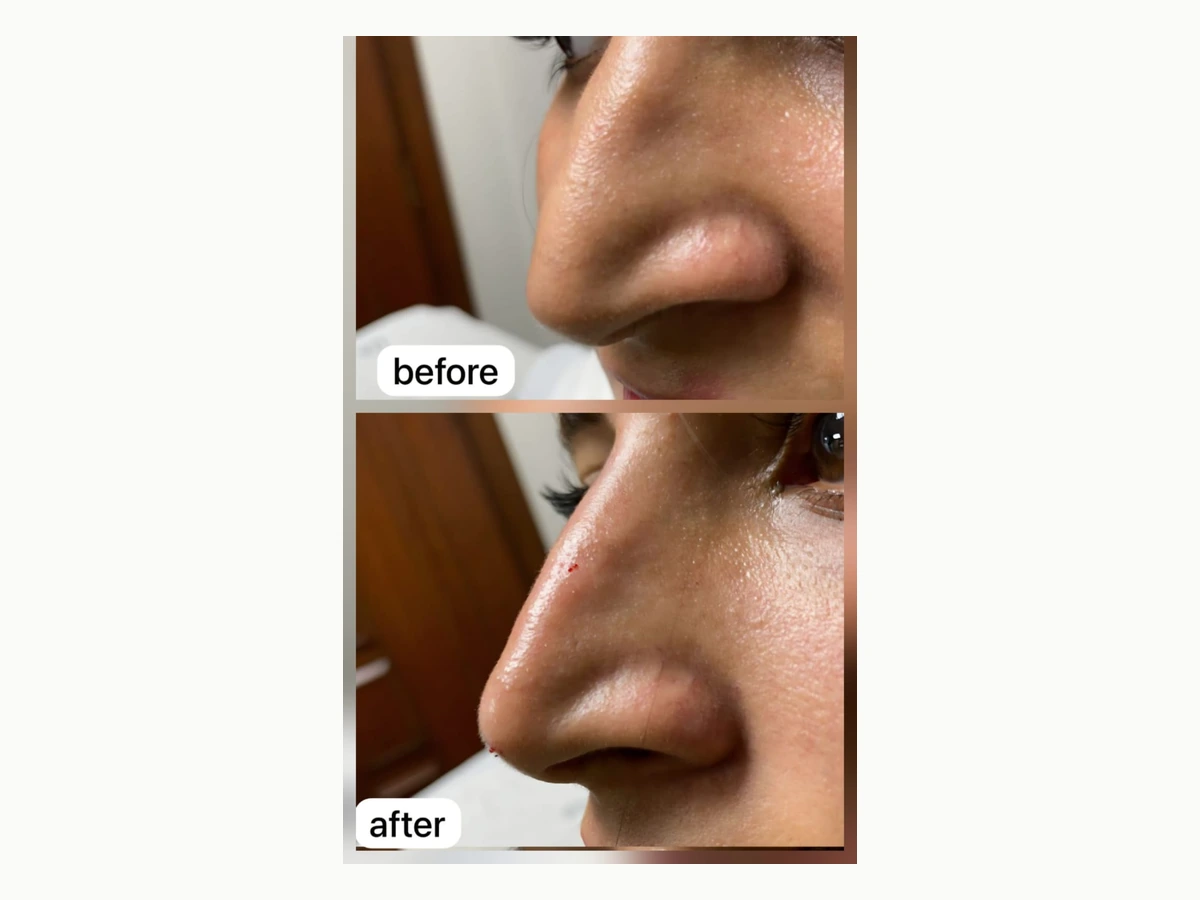 Liquid rhinoplasty before and after