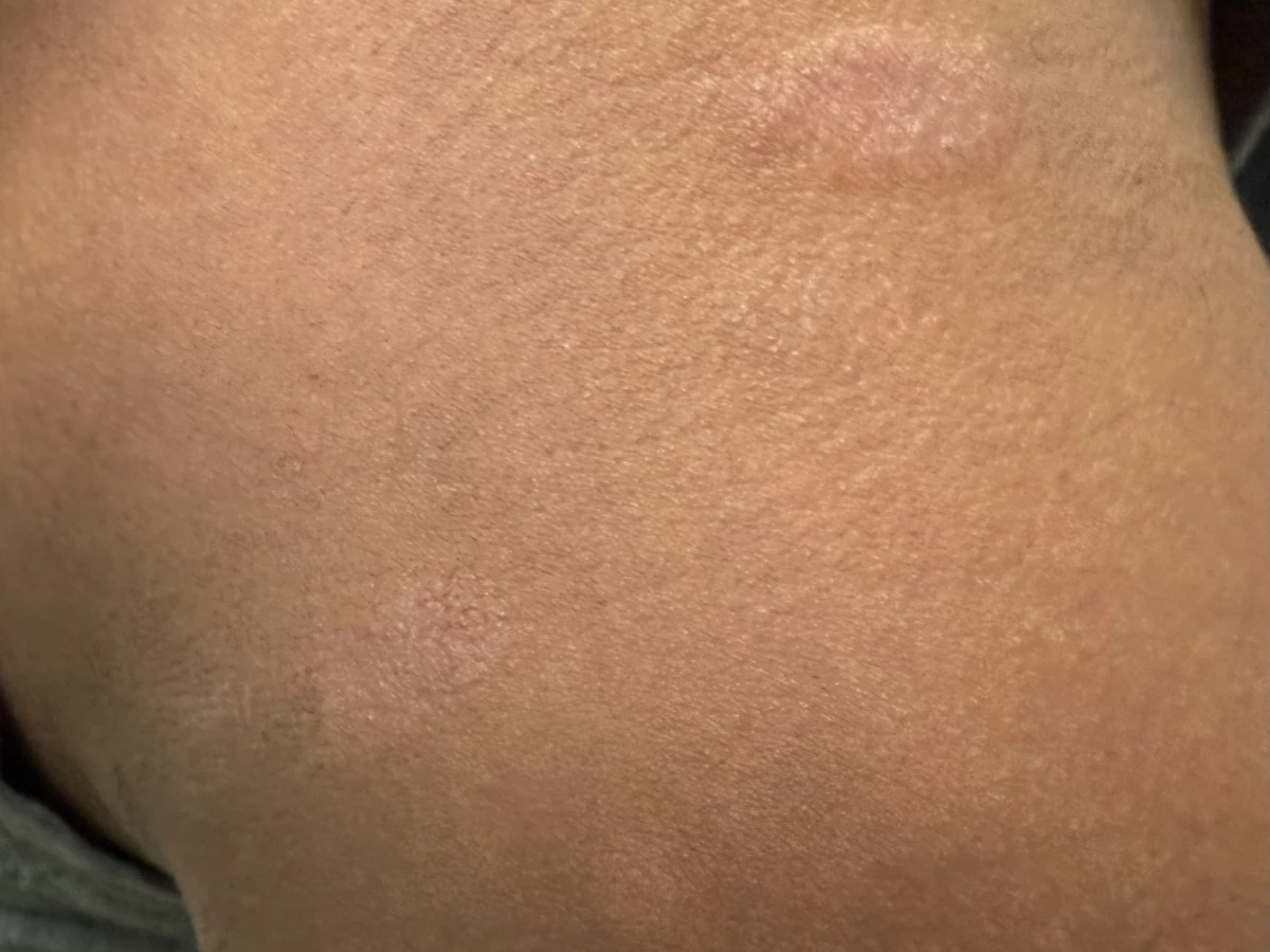Clinical photograph showing ringworm or tinea corporis on the skin